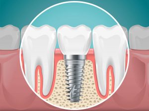 Parker dental implants